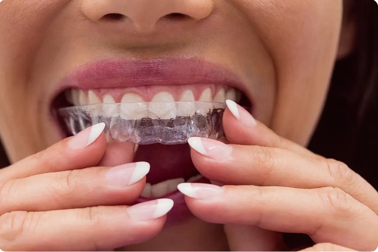 Palatal Expansion for Adults: Can You Widen the Palate Without Surgery?