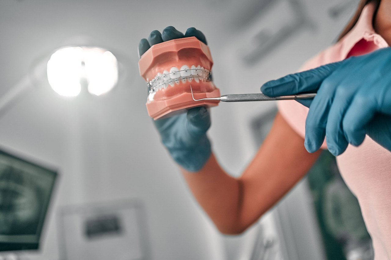 Provider pointing out bracket placement on a dental arch model fitted with braces