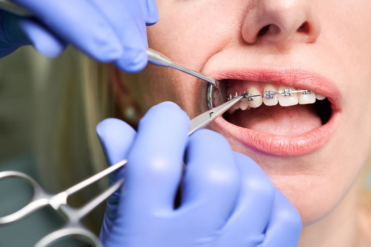 Close-up of orthodontic brackets being adjusted on a patient's upper teeth
