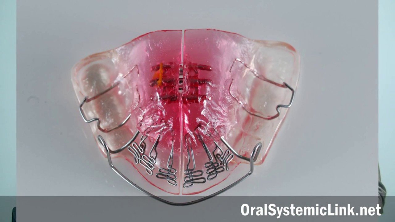 Video thumbnail — Dr. David Singh discusses the DNA appliance for airway development