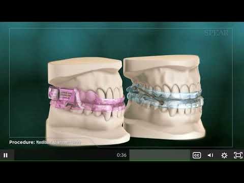Video thumbnail — how a mandibular advancement device (MAD) treats snoring and sleep apnea