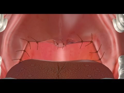 Video thumbnail — modified UPPP surgery as a sleep apnea treatment option