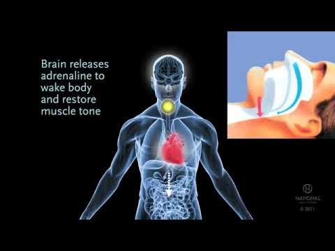 Video thumbnail — what obstructive sleep apnea is and how it affects you